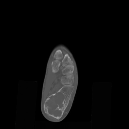 File:Aneurysmal bone cyst of the calcaneus (Radiopaedia 60669-68421 Axial bone window 11).jpg