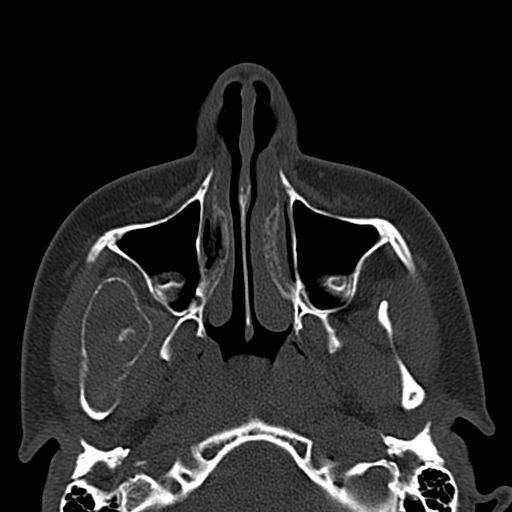 Aneurysmal bone cyst of the mandible (Radiopaedia 43280-46601 Axial bone window 65).jpg