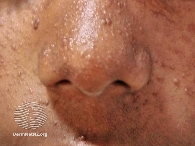 File:Angiofibromas in tuberous sclerosis (DermNet NZ facial-angiofibromas-12).jpg