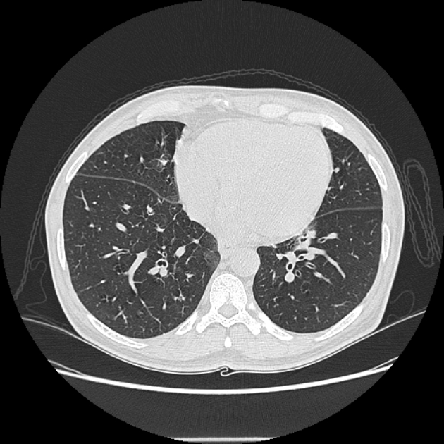 Angioinvasive aspergellosis (Radiopaedia 66995-76315 Axial lung window 35).jpg