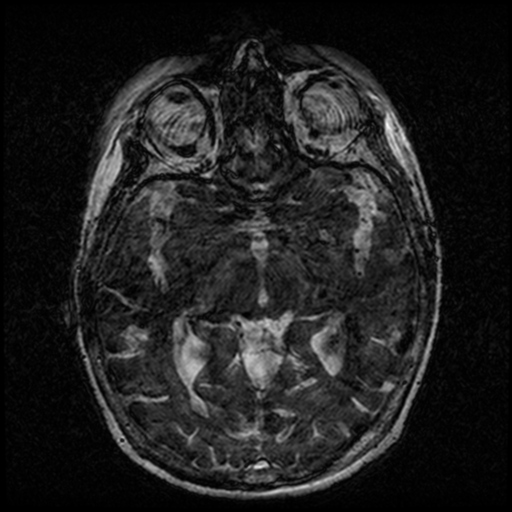 Angioinvasive aspergillosis in the pituitary fossa (Radiopaedia 39676-42010 Ax 3D FIESTA VOLUME 82).png