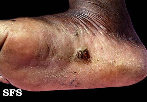 File:Angiosarcoma (Dermatology Atlas 1).jpg