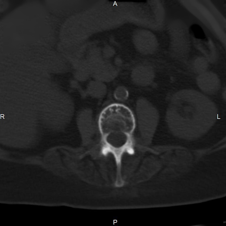 Ankylosing spondylitis (Radiopaedia 8748-9556 Axial bone window 27).jpg