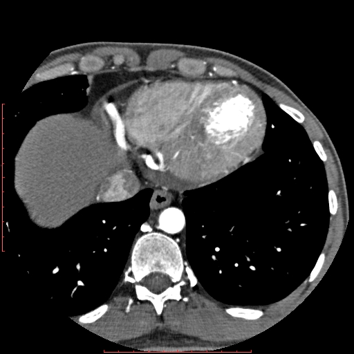 File:Anomalous left coronary artery from the pulmonary artery (ALCAPA) (Radiopaedia 70148-80181 A 325).jpg