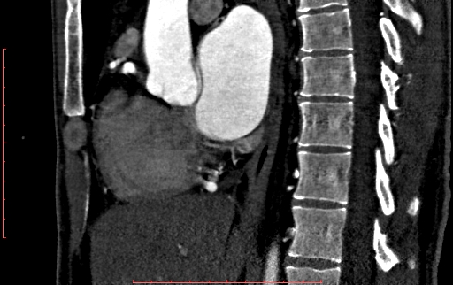 Anomalous left coronary artery from the pulmonary artery (ALCAPA) (Radiopaedia 70148-80181 C 102).jpg