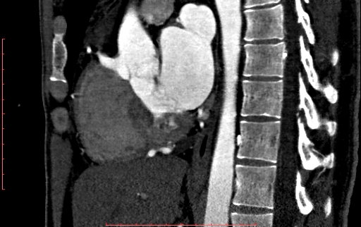 Anomalous left coronary artery from the pulmonary artery (ALCAPA) (Radiopaedia 70148-80181 C 117).jpg