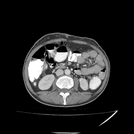 Anorectal carcinoma (Radiopaedia 44413-48064 A 26).jpg
