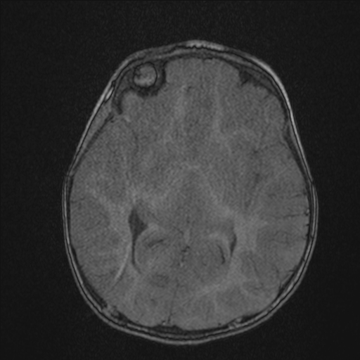 Anoxic brain injury (Radiopaedia 79165-92139 Axial MRA 117).jpg