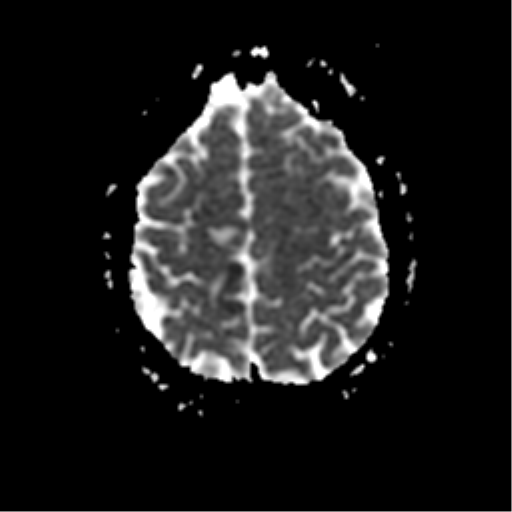 File:Anterior cerebral artery territory infarct (Radiopaedia 39327-41584 Axial ADC 21).png