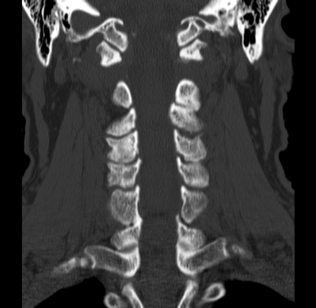 Anterior cervical postdiscectomy arthrodesis (Radiopaedia 32678-33646 Coronal bone window 38).jpg