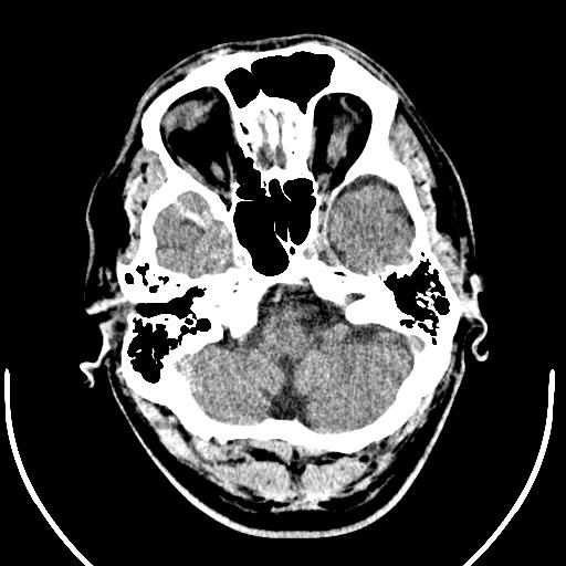 Anterior choroidal artery infarct (Radiopaedia 55106-61480 Axial non-contrast 8).jpg