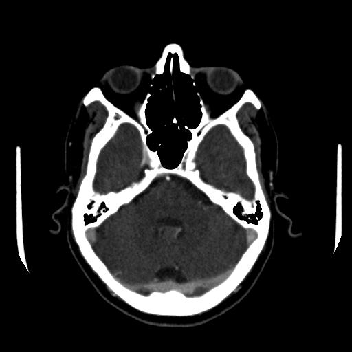 File:Anterior communicating artery aneurysm (Radiopaedia 16633-16335 A 11).jpg