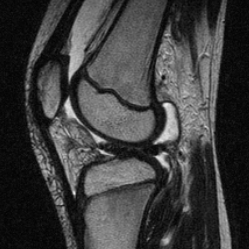 File:Anterior cruciate ligament avulsion fracture (Radiopaedia 24710-24974 Sagittal T2 11).jpg