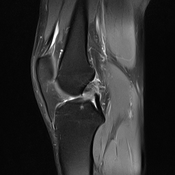 File:Anterior cruciate ligament full thickness tear (Radiopaedia 66268-75467 Sagittal PD fat sat 12).jpg