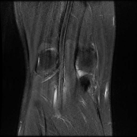 File:Anterior cruciate ligament graft tear and bucket-handle tear of medial meniscus (Radiopaedia 75867-87254 Coronal PD fat sat 20).jpg