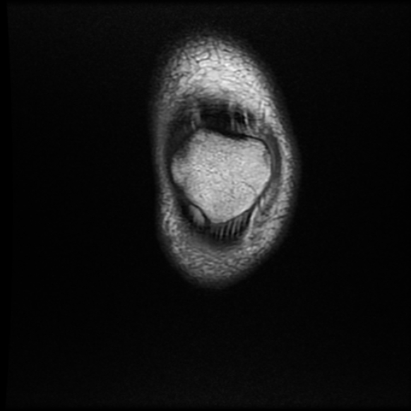 File:Anterior cruciate ligament graft tear and bucket-handle tear of medial meniscus (Radiopaedia 75867-87255 Coronal T1 2).jpg