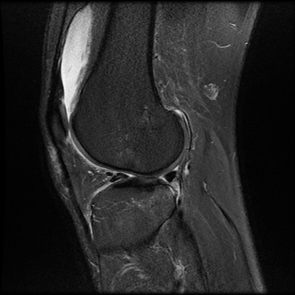 File:Anterior cruciate ligament graft tear and bucket-handle tear of medial meniscus (Radiopaedia 75867-87255 Sagittal PD fat sat 20).jpg