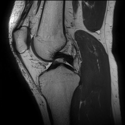 Anterior cruciate ligament rupture and posteromedial corner injury (Radiopaedia 67338-76723 Sagittal PD 77).jpg