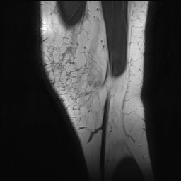 Anterior cruciate ligament rupture with Segond fracture (Radiopaedia 69043-78806 Sagittal PD 14).jpg