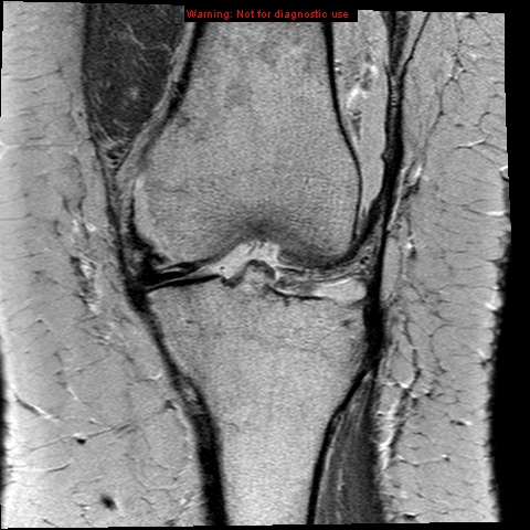 File:Anterior cruciate ligament tear - complete (Radiopaedia 12175-12514 C 6).jpg