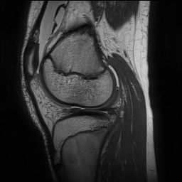 Anterior cruciate ligament tear - pediatric (Radiopaedia 62152-70260 Sagittal PD 117).jpg