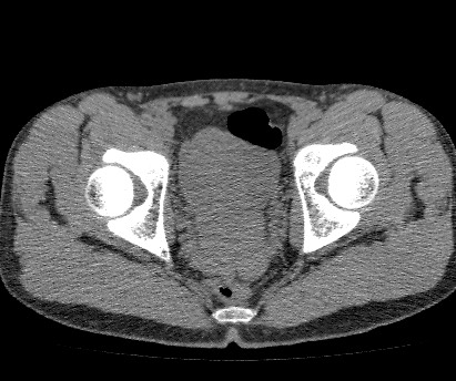File:Anterior inferior iliac spine avulsion fracture (Radiopaedia 81312-94999 Axial non-contrast 52).jpg