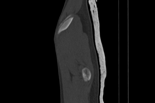 Anterior inferior iliac spine avulsion injury (Radiopaedia 88666-105376 Sagittal bone window 11).jpg