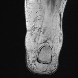 File:Anterior talofibular ligament injury - rupture with soft-tissue impingement (Radiopaedia 38765-40928 Coronal PD 7).jpg