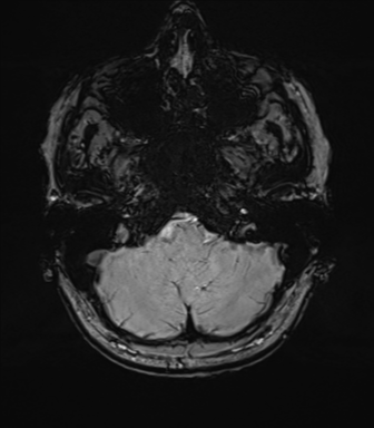 Anterior temporal lobe perivascular space (Radiopaedia 40946-43650 Axial SWI 14).png
