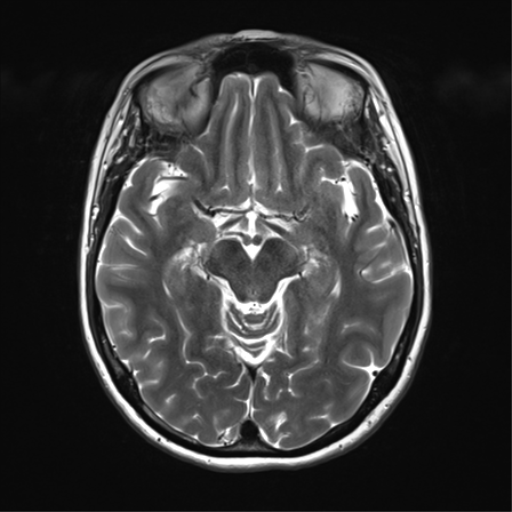 File:Anterior temporal lobe perivascular space (Radiopaedia 40946-43650 Axial T2 16).png