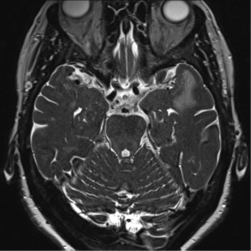 Anterior temporal pole cysts (Radiopaedia 46629-51102 Axial 39).png