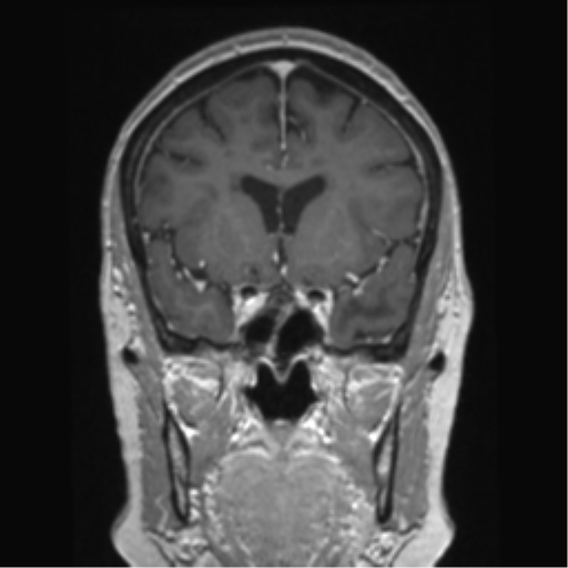 Anterior temporal pole cysts (Radiopaedia 46629-51102 Coronal T1 C+ 111).png