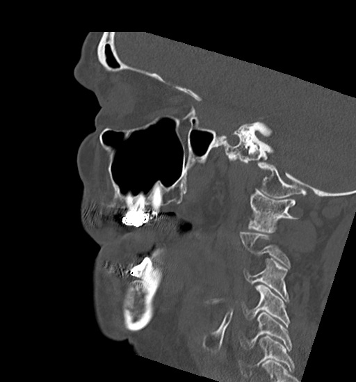 File:Anterior temporomandibular joint dislocation (Radiopaedia 59430-66784 B 21).jpg