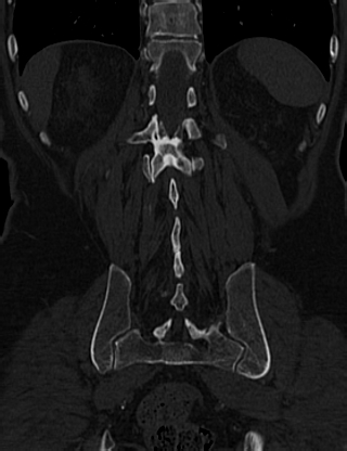 Anterior vertebral scalloping (abdominal aortic aneurysm) (Radiopaedia 66744-76067 Coronal bone window 57).jpg