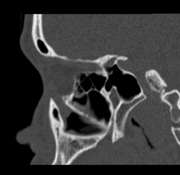 Antrochoanal polyp (Radiopaedia 33984-35202 Sagittal bone window 53).jpg