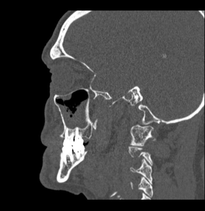 Antrochoanal polyp (Radiopaedia 79011-92169 Sagittal bone window 3).jpg