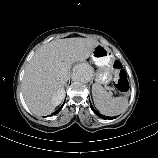 Aortic aneurysm and Lemmel syndrome (Radiopaedia 86499-102554 Axial C+ delayed 17).jpg