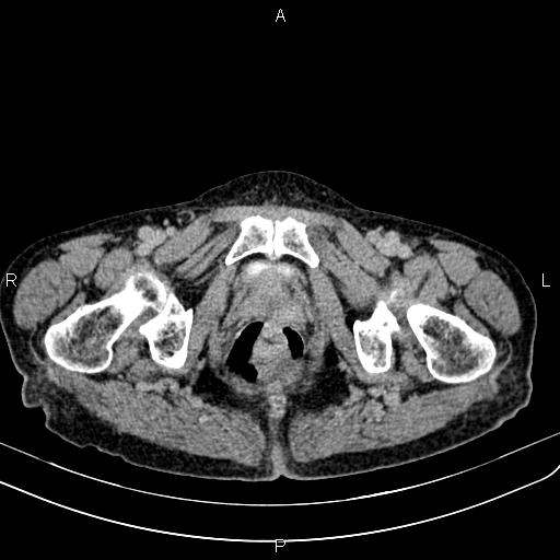 File:Aortic aneurysm and Lemmel syndrome (Radiopaedia 86499-102554 Axial C+ delayed 80).jpg