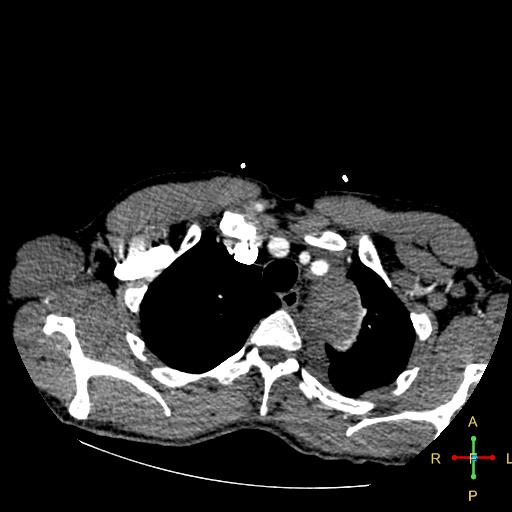 File:Aortic aneurysm and penetrating ulcer (Radiopaedia 23590-23704 A 5).jpg