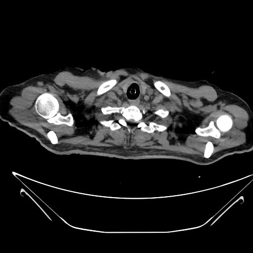 Aortic arch aneurysm (Radiopaedia 84109-99365 Axial non-contrast 22).jpg