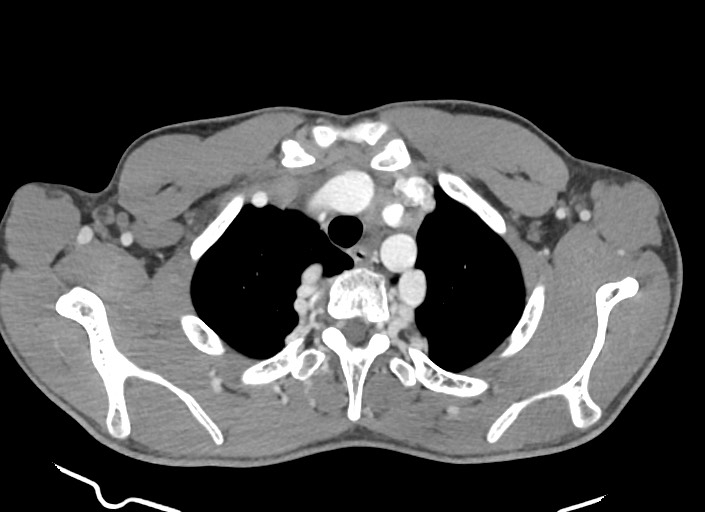 File:Aortic coarctation with aneurysm (Radiopaedia 74818-85828 A 165).jpg