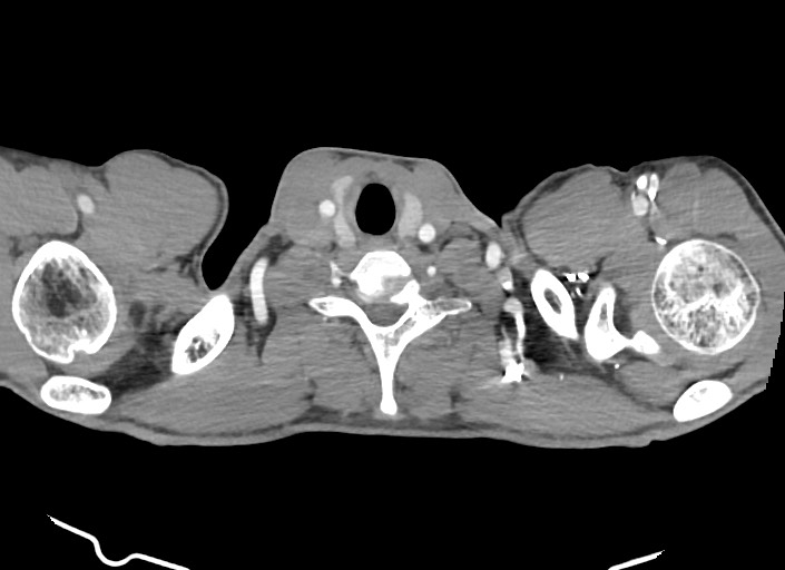 File:Aortic coarctation with aneurysm (Radiopaedia 74818-85828 A 191).jpg