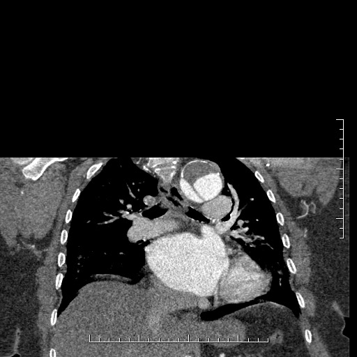 Aortic dissection- Stanford A (Radiopaedia 35729-37268 E 23).jpg