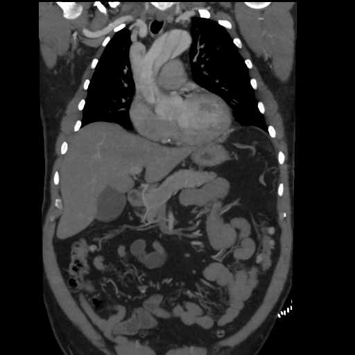 File:Aortic dissection- Stanford A (Radiopaedia 37759-39664 Coronal C+ delayed 17).png