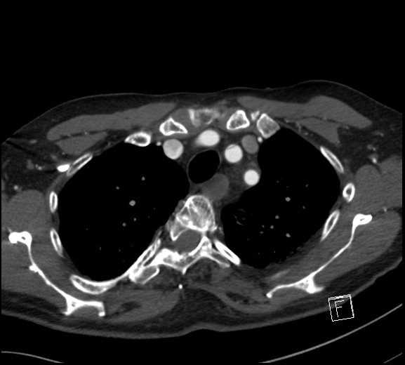 File:Aortic dissection (CTPA) (Radiopaedia 75506-86750 A 20).jpg