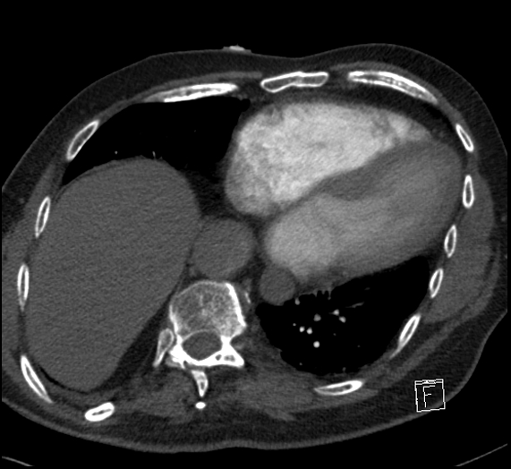File:Aortic dissection (CTPA) (Radiopaedia 75506-86751 Axial C+ CTPA 99).jpg