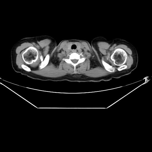 Aortic dissection (Radiopaedia 25350-25604 B 5).jpg