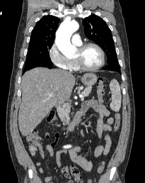 Aortic dissection (Radiopaedia 44411-48061 A 12).jpg