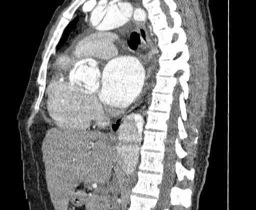 File:Aortic dissection - Stanford A -DeBakey I (Radiopaedia 28339-28587 C 30).jpg