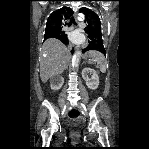 File:Aortic dissection - Stanford type B (Radiopaedia 88281-104910 B 45).jpg